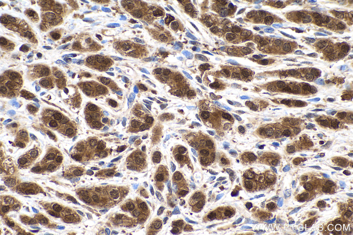 Immunohistochemical analysis of paraffin-embedded human prostate cancer tissue slide using KHC0238 (FABP5 IHC Kit).