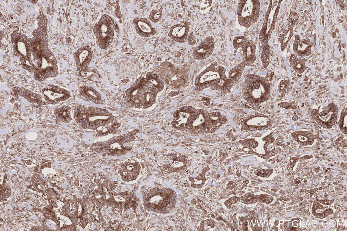 Immunohistochemical analysis of paraffin-embedded human rectal cancer tissue slide using KHC2783 (FAF2 IHC Kit).