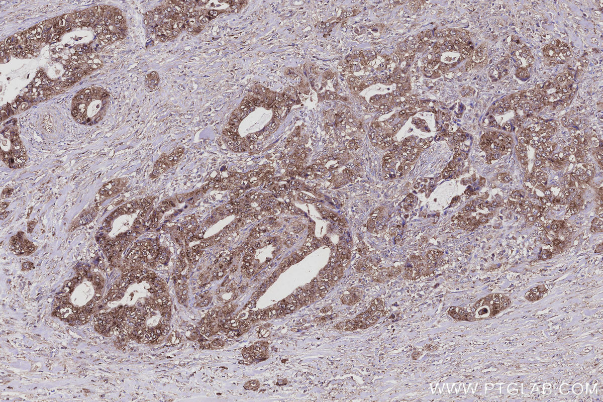 Immunohistochemical analysis of paraffin-embedded human pancreas cancer tissue slide using KHC3099 (FAM13A IHC Kit).