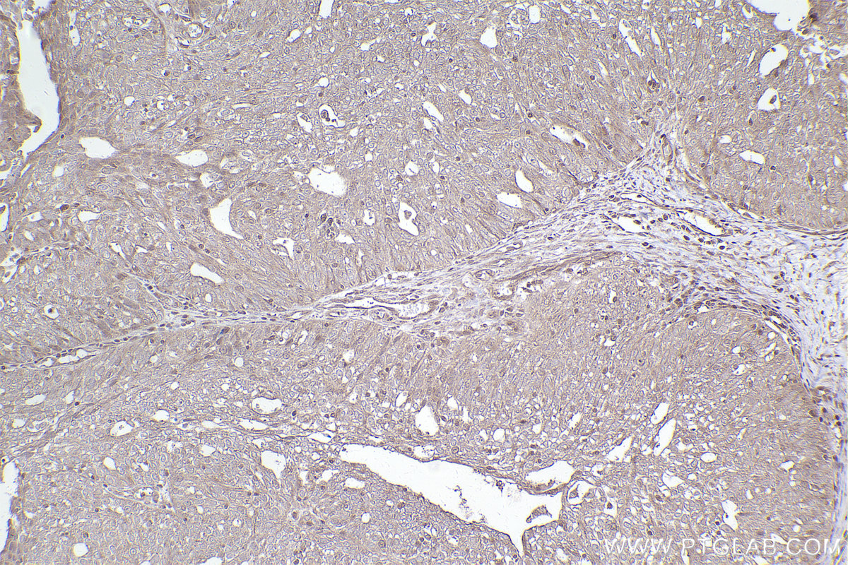 Immunohistochemical analysis of paraffin-embedded human ovary cancer tissue slide using KHC2477 (FAM175B IHC Kit).
