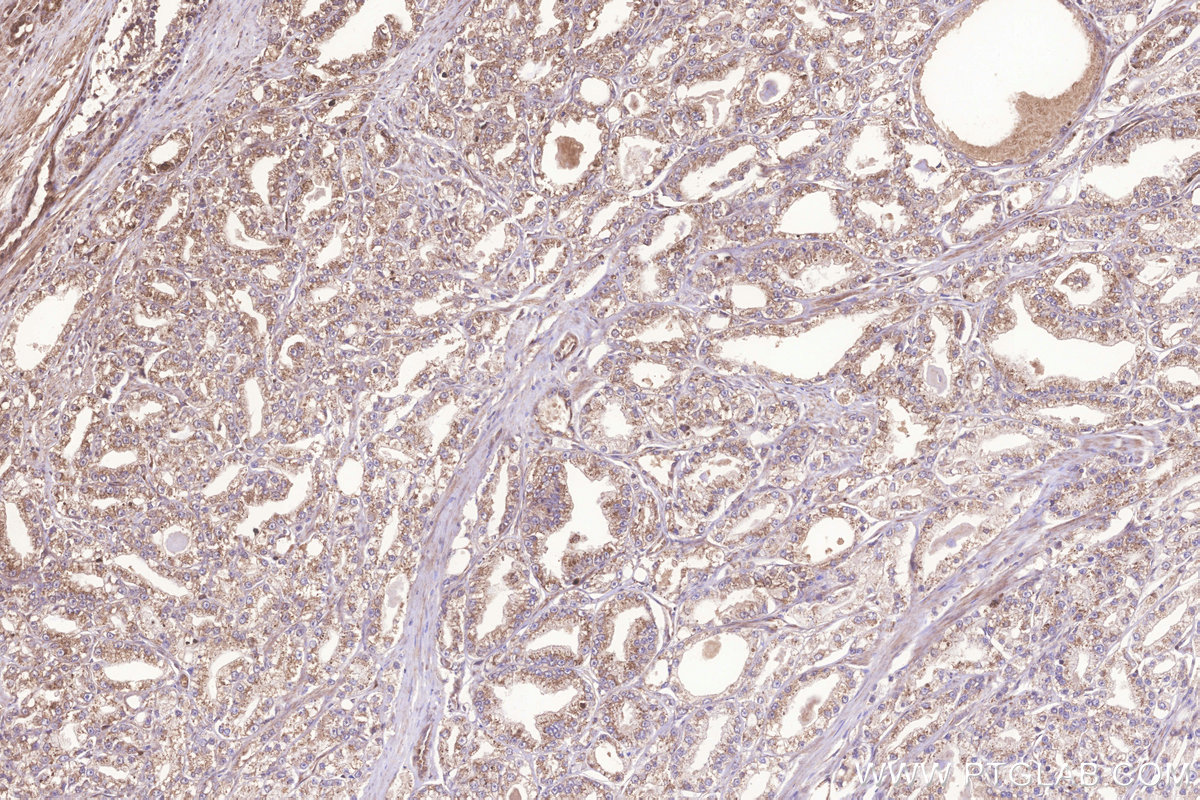 Immunohistochemical analysis of paraffin-embedded human prostate cancer tissue slide using KHC3266 (FAM46C IHC Kit).