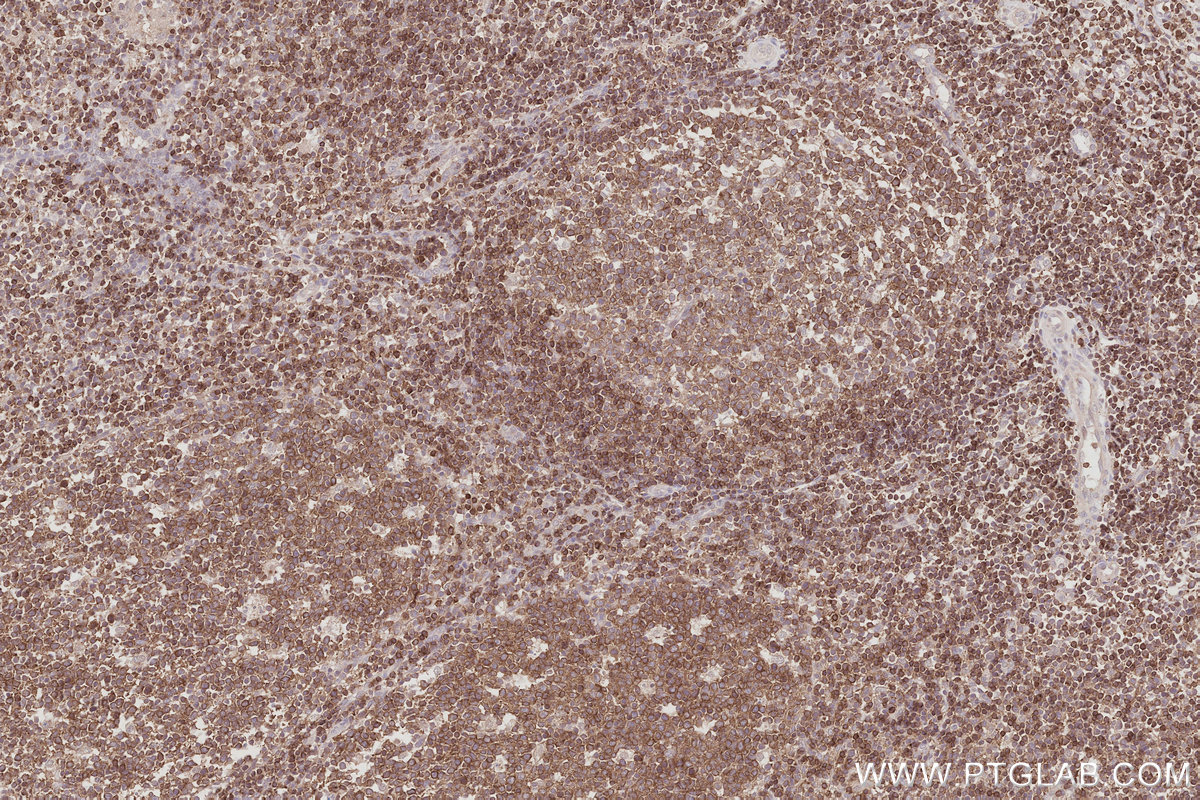 Immunohistochemical analysis of paraffin-embedded human tonsillitis tissue slide using KHC3073 (FAM65B IHC Kit). Immunohistochemical analysis of paraffin-embedded human tonsillitis tissue slide using KHC3073 (FAM65B IHC Kit).
