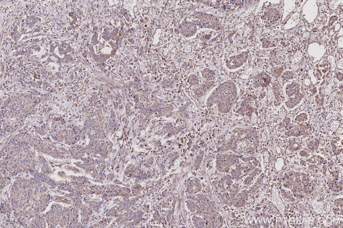 Immunohistochemical analysis of paraffin-embedded human stomach cancer tissue slide using KHC3123 (FAM8A1 IHC Kit).