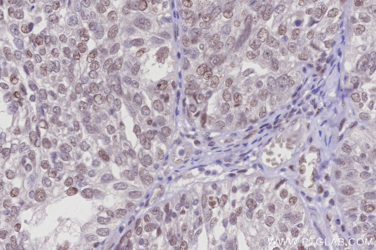 Immunohistochemical analysis of paraffin-embedded human ovary cancer tissue slide using KHC2958 (FANCI IHC Kit).