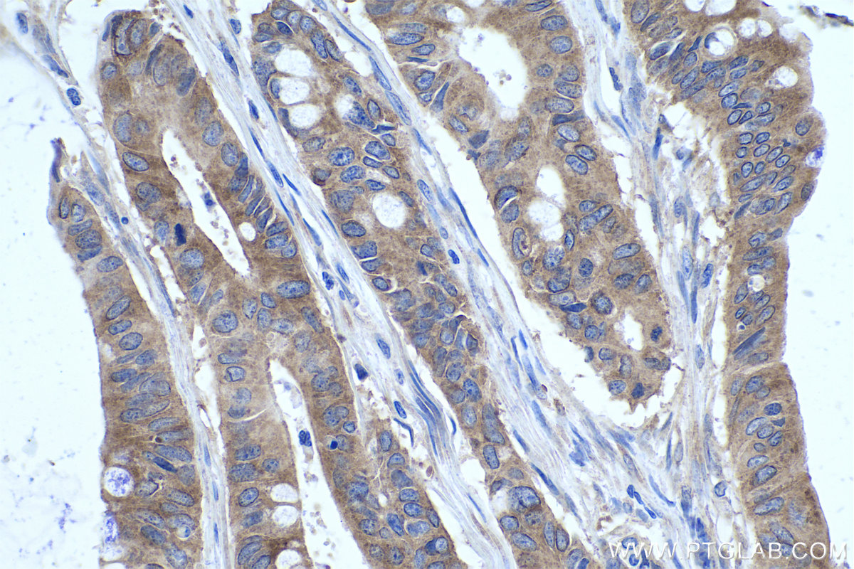 Immunohistochemical analysis of paraffin-embedded human colon cancer tissue slide using KHC0416 (FARSB IHC Kit).