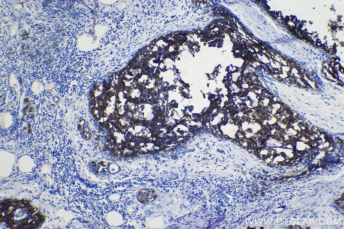 Immunohistochemical analysis of paraffin-embedded human breast cancer tissue slide using KHC1103 (FASN IHC Kit).