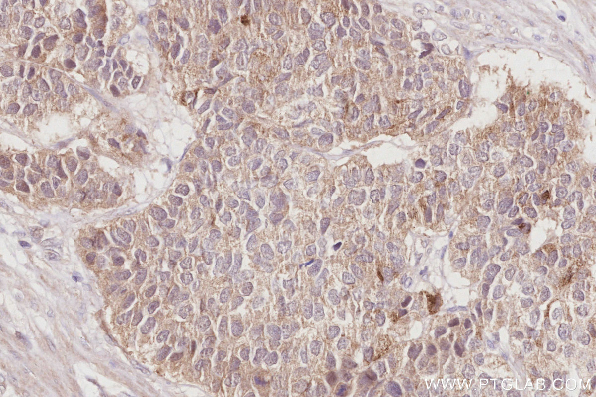 Immunohistochemical analysis of paraffin-embedded human stomach cancer tissue slide using KHC2915 (FBXL15 IHC Kit).