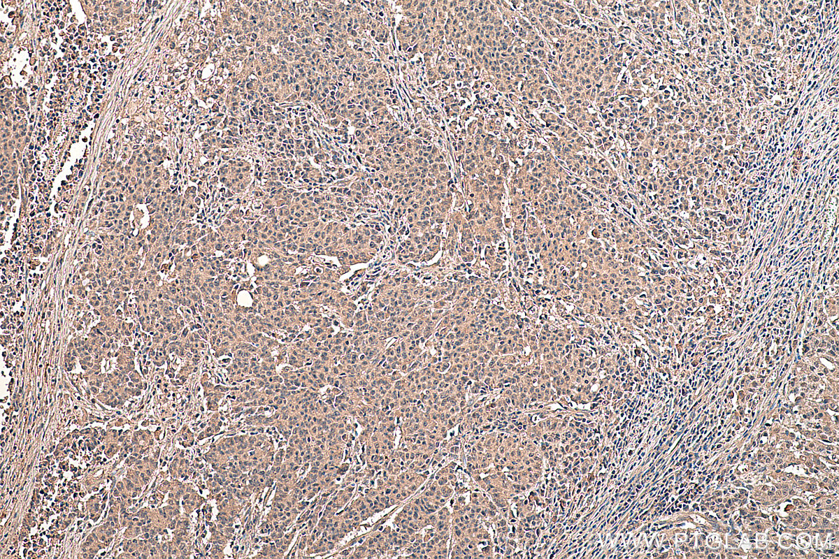 Immunohistochemical analysis of paraffin-embedded human stomach cancer tissue slide using KHC0329 (FBXO32 IHC Kit).