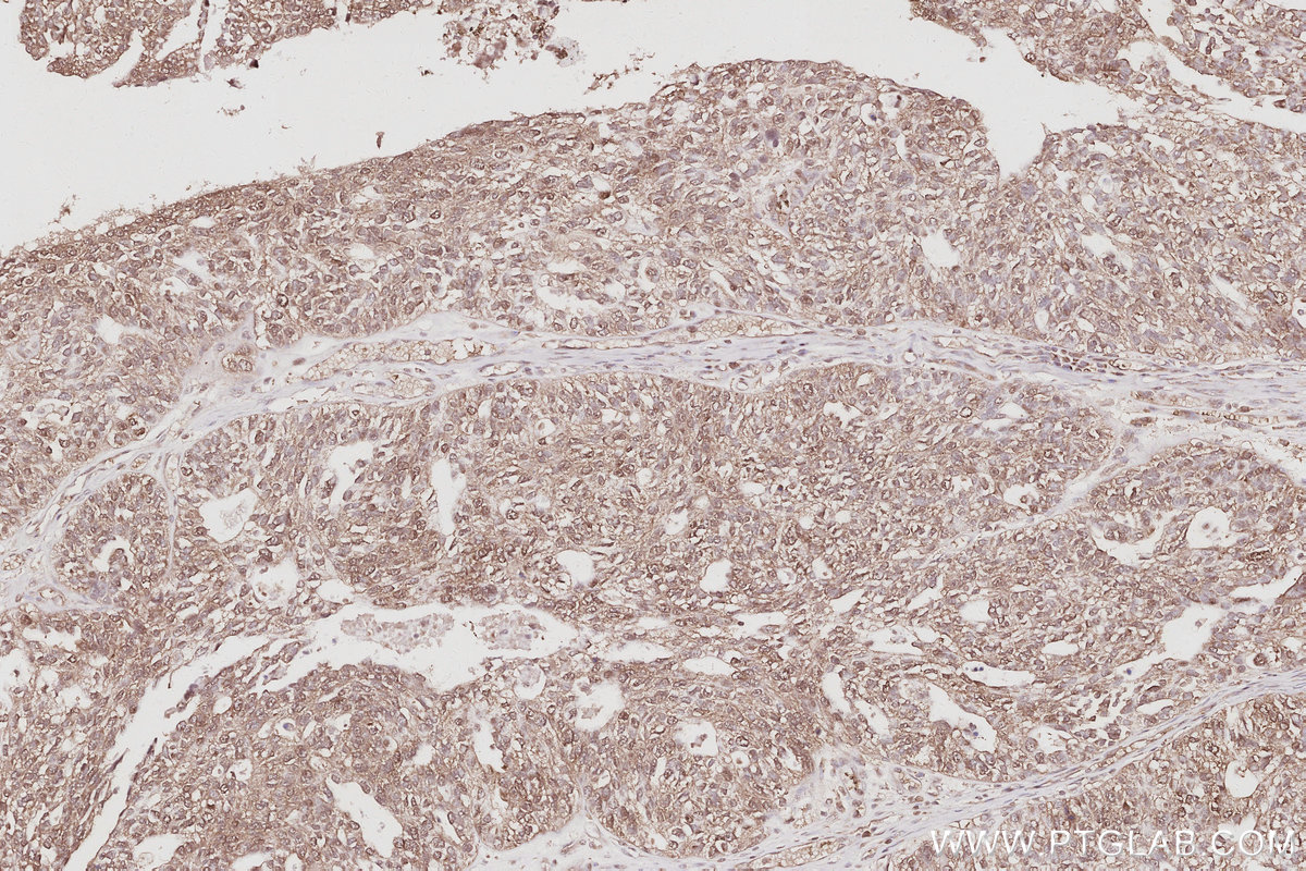 Immunohistochemical analysis of paraffin-embedded human ovary cancer tissue slide using KHC3063 (FBXO7 IHC Kit). Immunohistochemical analysis of paraffin-embedded human ovary cancer tissue slide using KHC3063 (FBXO7 IHC Kit).