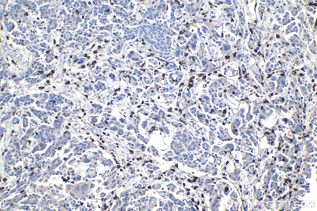 Immunohistochemical analysis of paraffin-embedded human colon cancer tissue slide using KHC0941 (FCGR2A/CD32A IHC Kit).