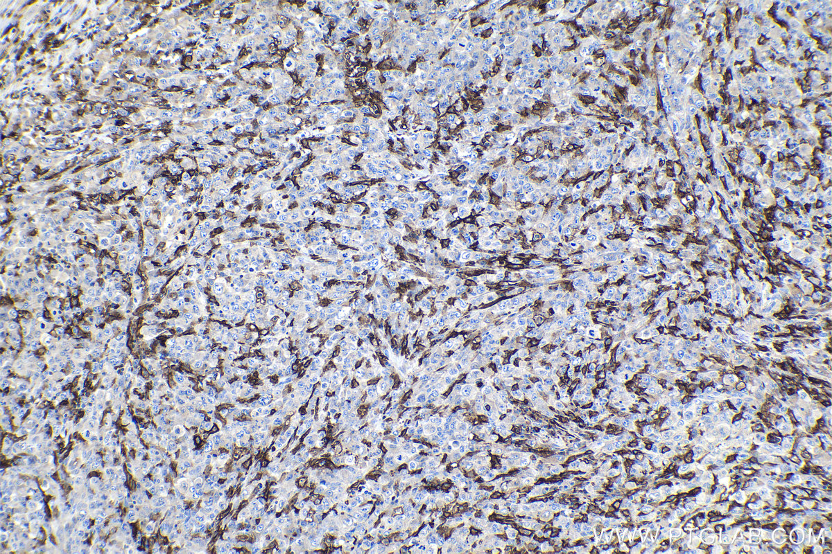 Immunohistochemical analysis of paraffin-embedded human lymphoma tissue slide using KHC0941 (FCGR2A/CD32A IHC Kit).