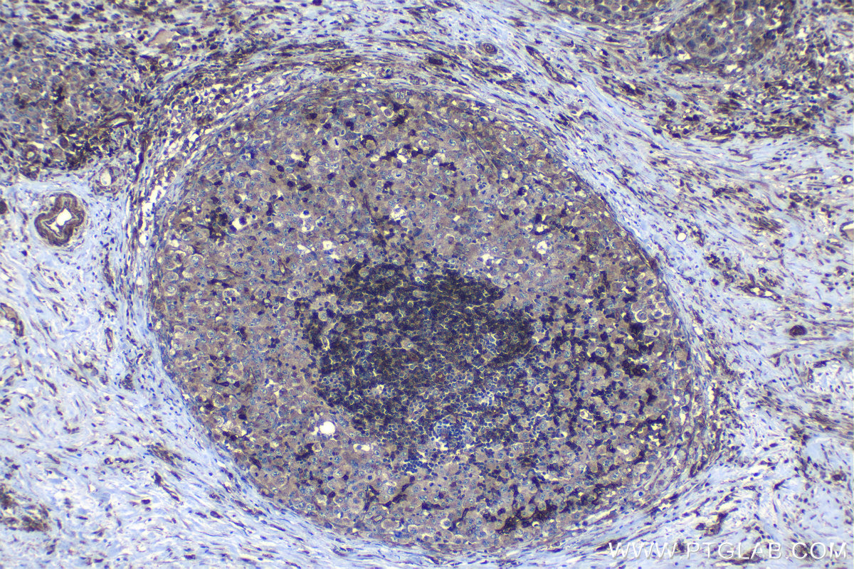 Immunohistochemical analysis of paraffin-embedded human lymphoma tissue slide using KHC1163 (FCGR2B IHC Kit).