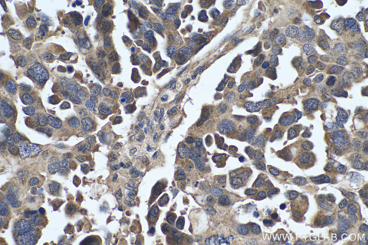 Immunohistochemical analysis of paraffin-embedded human colon cancer tissue slide using KHC0775 (FERMT1/Kindlin 1 IHC Kit).