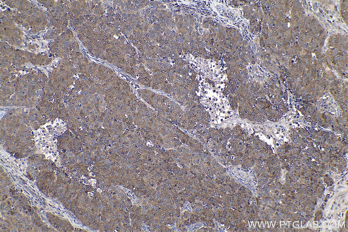 Immunohistochemical analysis of paraffin-embedded human stomach cancer tissue slide using KHC0775 (FERMT1/Kindlin 1 IHC Kit).