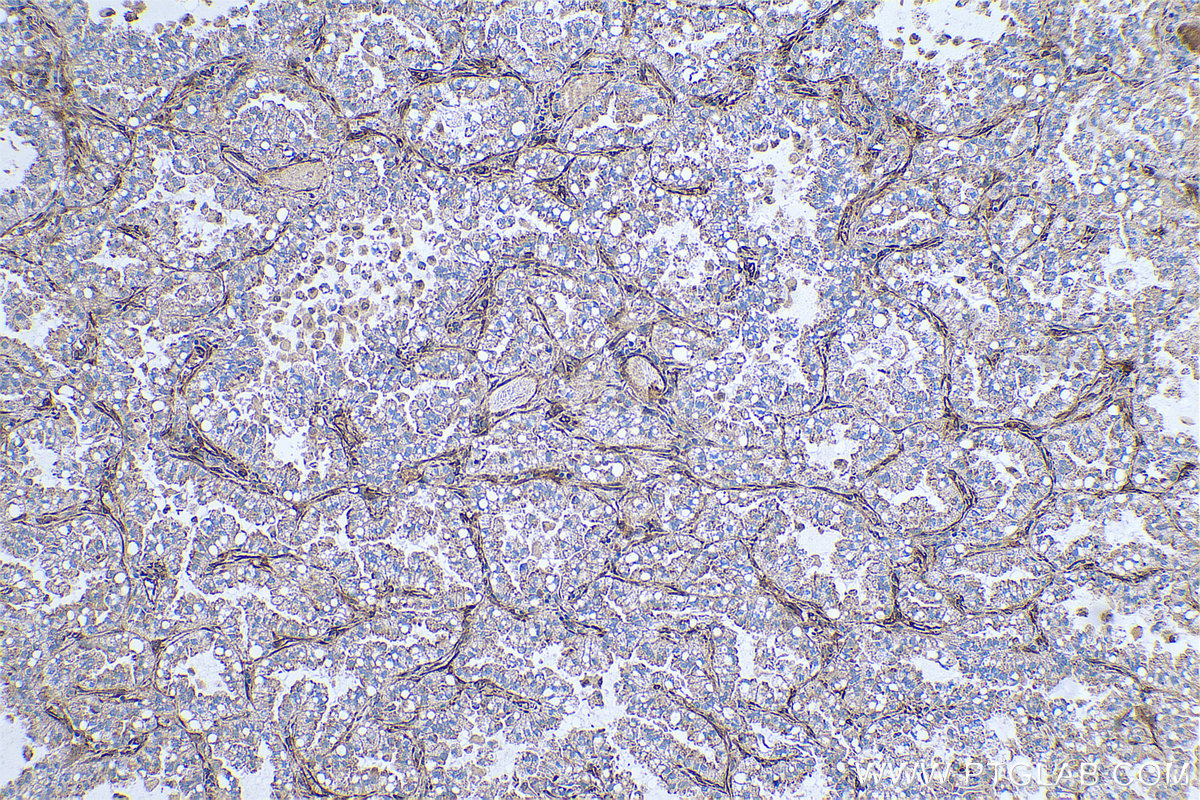 Immunohistochemical analysis of paraffin-embedded human lung cancer tissue slide using KHC0688 (FERMT2/Kindlin 2 IHC Kit).