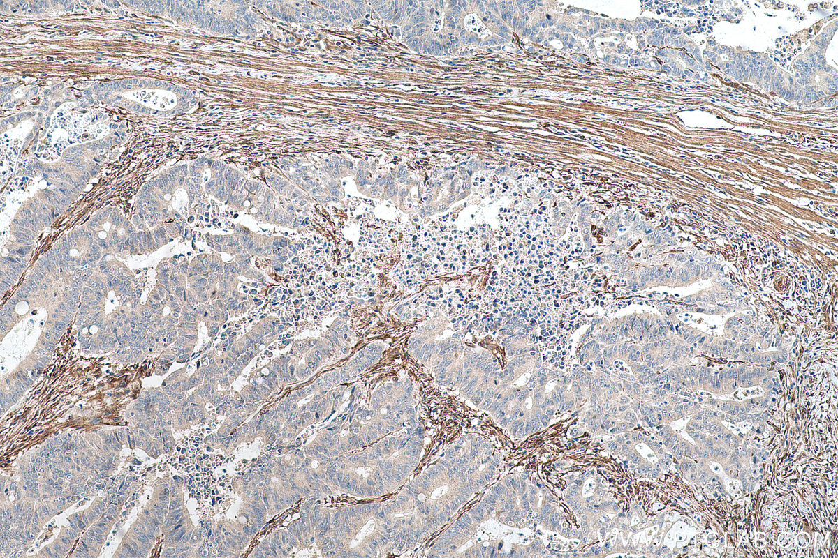 Immunohistochemical analysis of paraffin-embedded human colon cancer tissue slide using KHC0688 (FERMT2/Kindlin 2 IHC Kit).