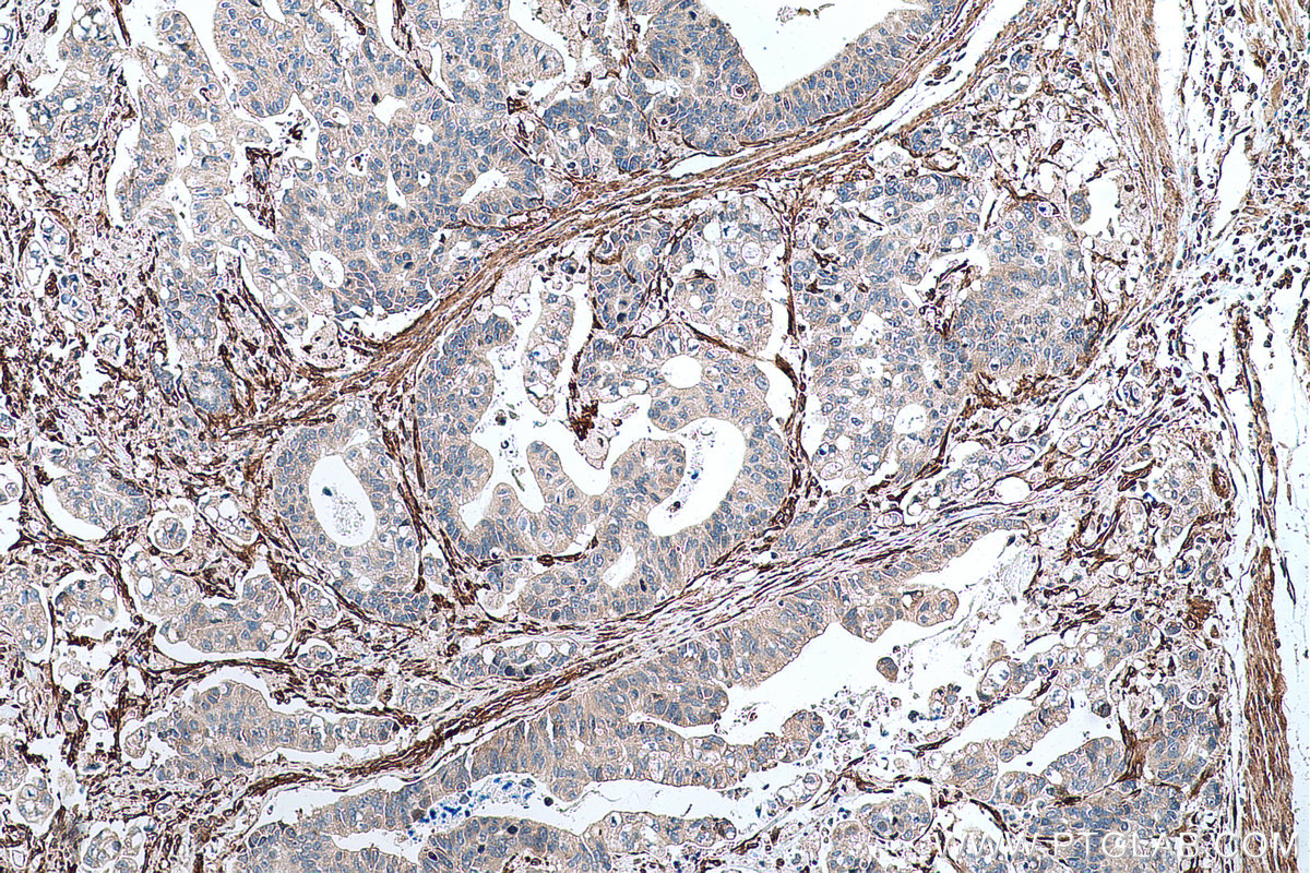 Immunohistochemical analysis of paraffin-embedded human stomach cancer tissue slide using KHC0688 (FERMT2/Kindlin 2 IHC Kit).