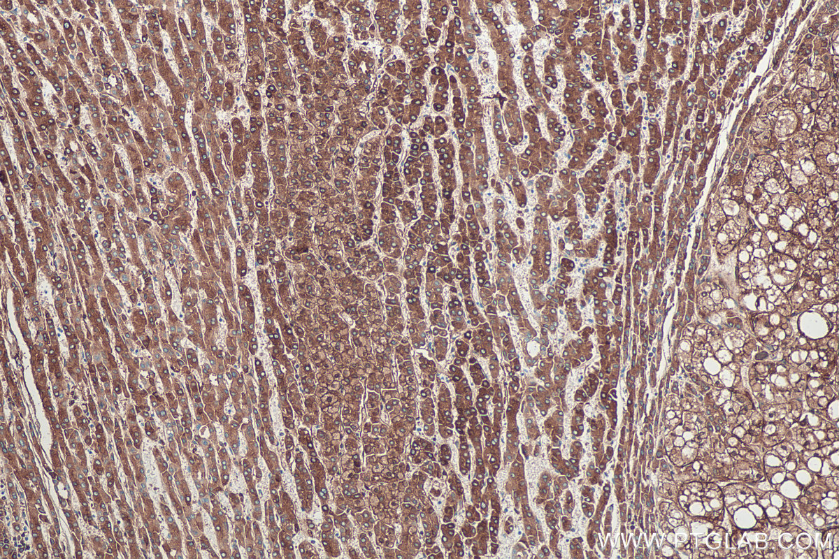 Immunohistochemical analysis of paraffin-embedded human liver cancer tissue slide using KHC0388 (Fibrinogen Beta Chain IHC Kit).