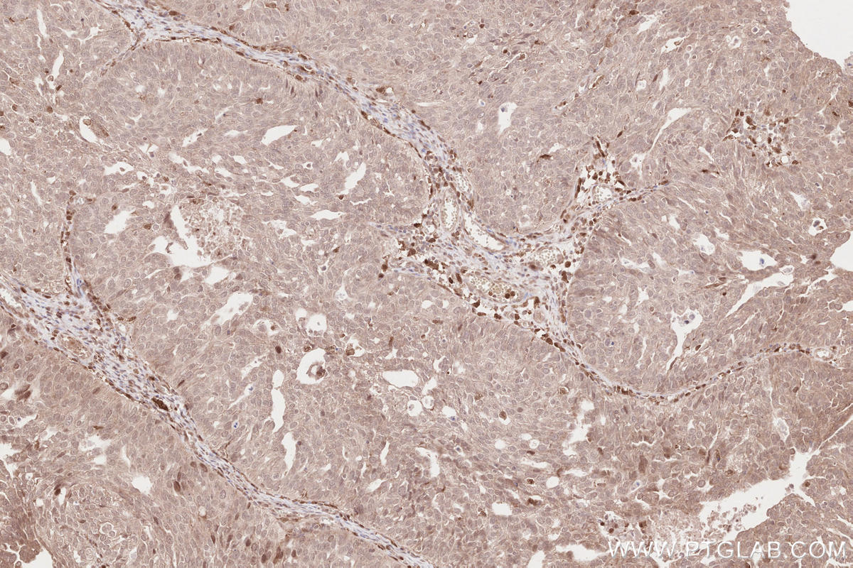 Immunohistochemical analysis of paraffin-embedded human ovary cancer tissue slide using KHC2626 (FGD2 IHC Kit).