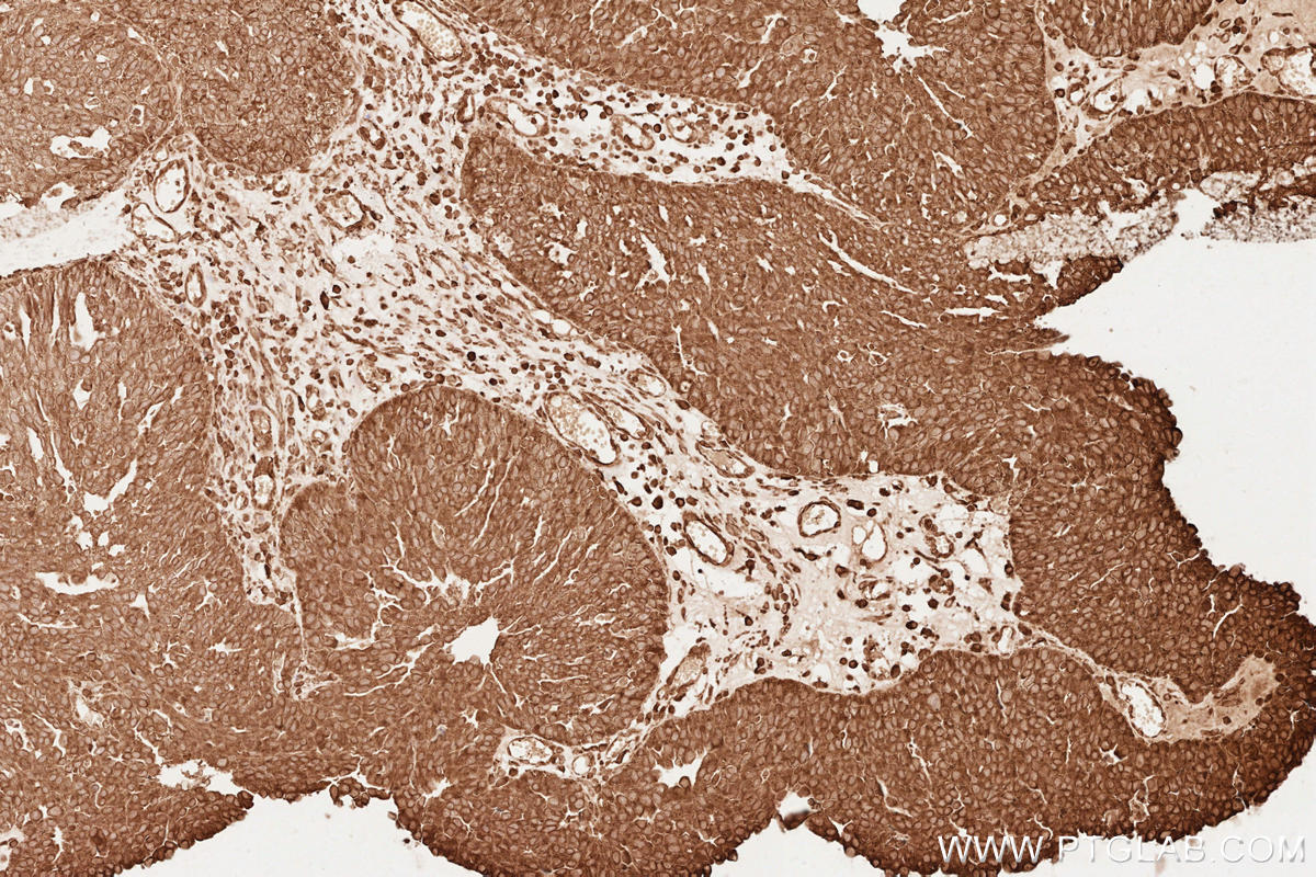 Immunohistochemical analysis of paraffin-embedded human ovary cancer tissue slide using KHC2545 (FGD3 IHC Kit).