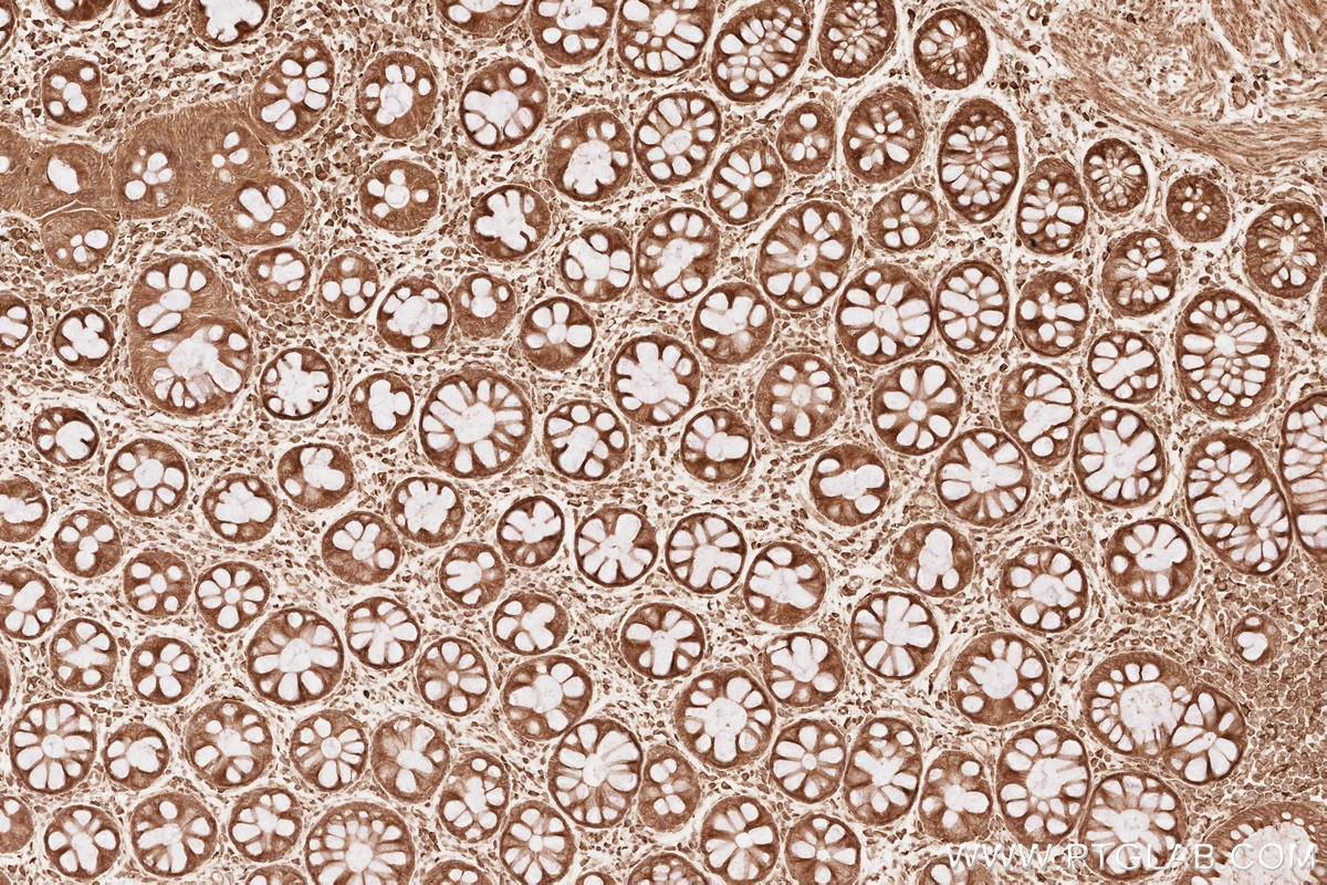 Immunohistochemical analysis of paraffin-embedded human rectal cancer tissue slide using KHC2545 (FGD3 IHC Kit).