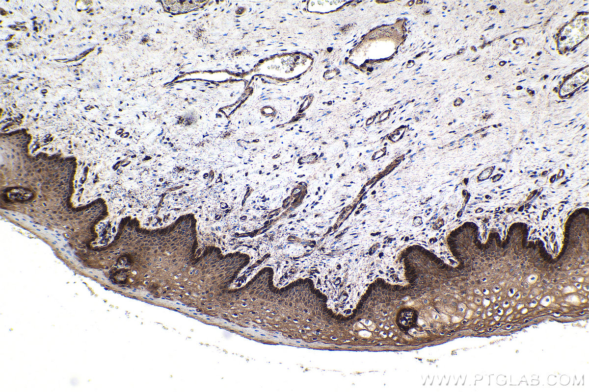 Immunohistochemical analysis of paraffin-embedded human cervical cancer tissue slide using KHC1727 (FHL2 IHC Kit).