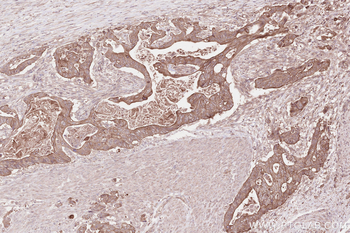 Immunohistochemical analysis of paraffin-embedded human stomach cancer tissue slide using KHC2591 (FIGNL1 IHC Kit).
