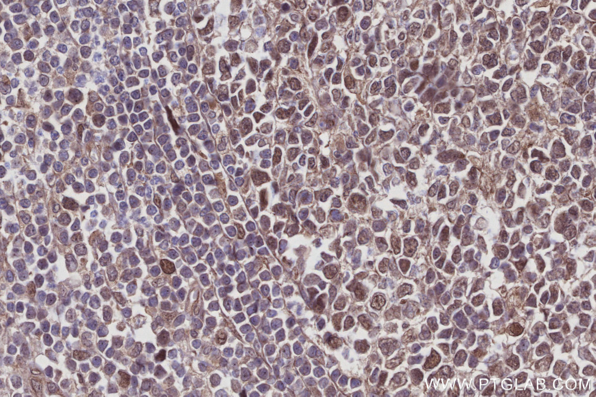 Immunohistochemical analysis of paraffin-embedded human appendicitis tissue slide using KHC2952 (FIRRM/C1orf112 IHC Kit).