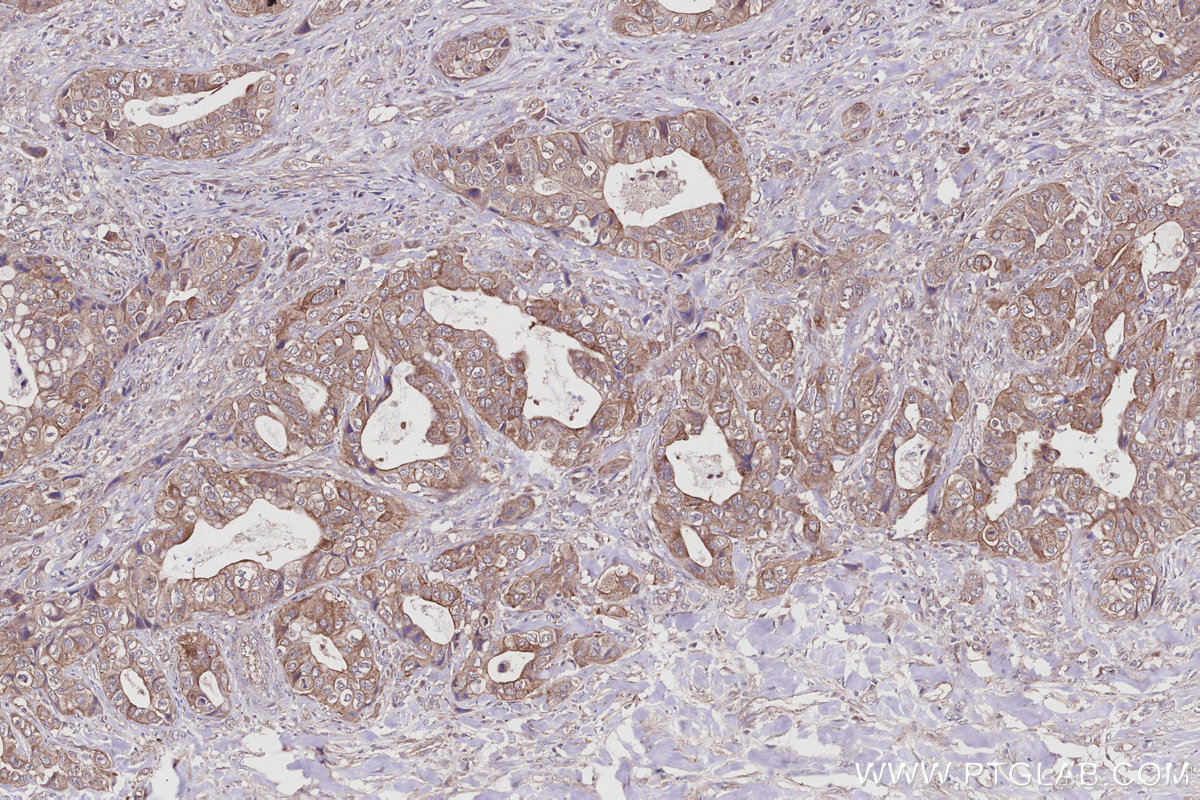 Immunohistochemical analysis of paraffin-embedded human pancreas cancer tissue slide using KHC2952 (FIRRM/C1orf112 IHC Kit).