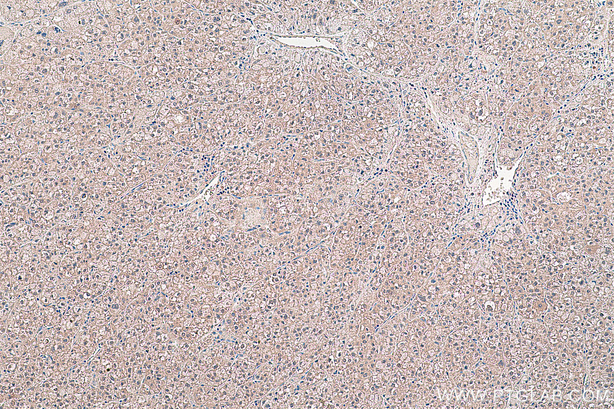 Immunohistochemical analysis of paraffin-embedded human liver cancer tissue slide using KHC0417 (FKBP4/FKBP52 IHC Kit).