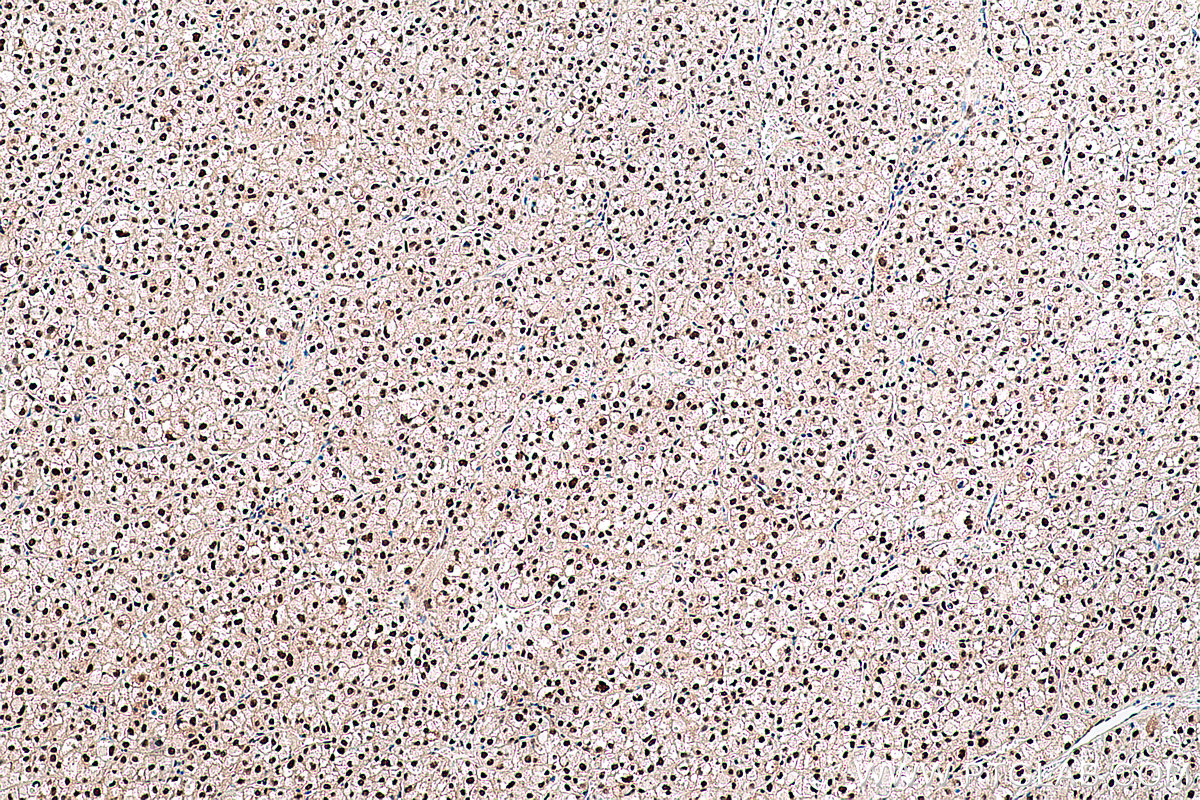 Immunohistochemical analysis of paraffin-embedded human liver cancer tissue slide using KHC0418 (FKBP5 IHC Kit).