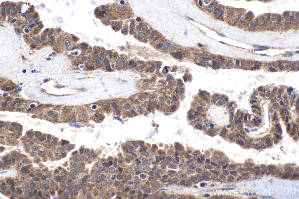 Immunohistochemical analysis of paraffin-embedded human thyroid cancer tissue slide using KHC1839 (FLCN IHC Kit).