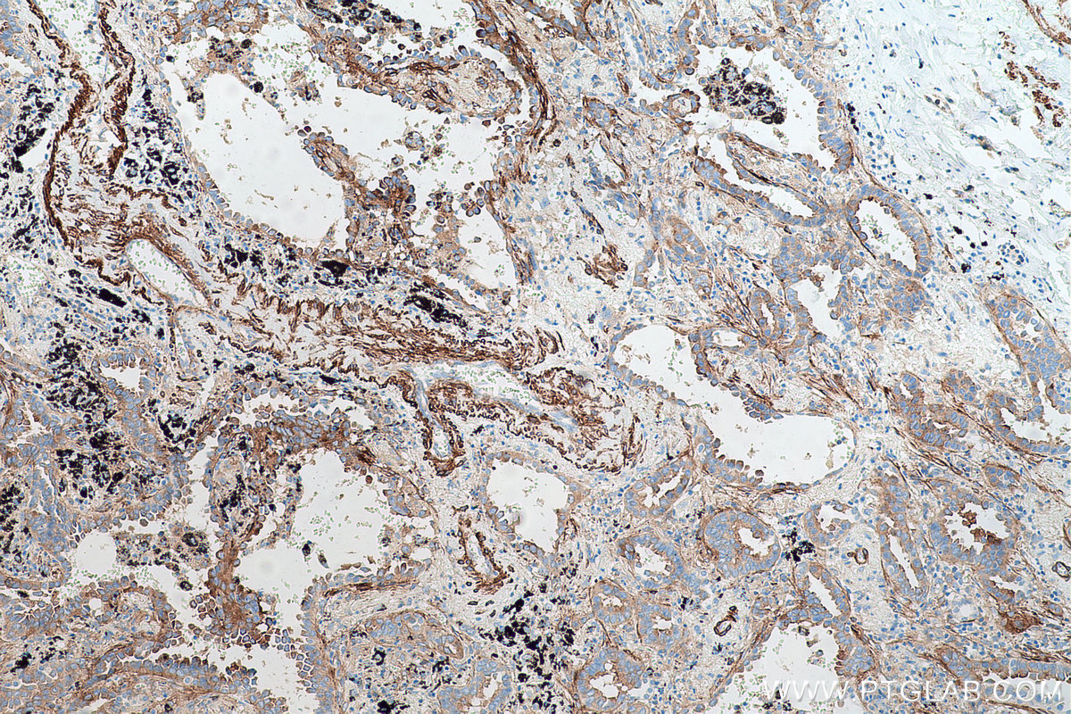 Immunohistochemical analysis of paraffin-embedded human lung cancer tissue slide using KHC0655 (FLNA IHC Kit).