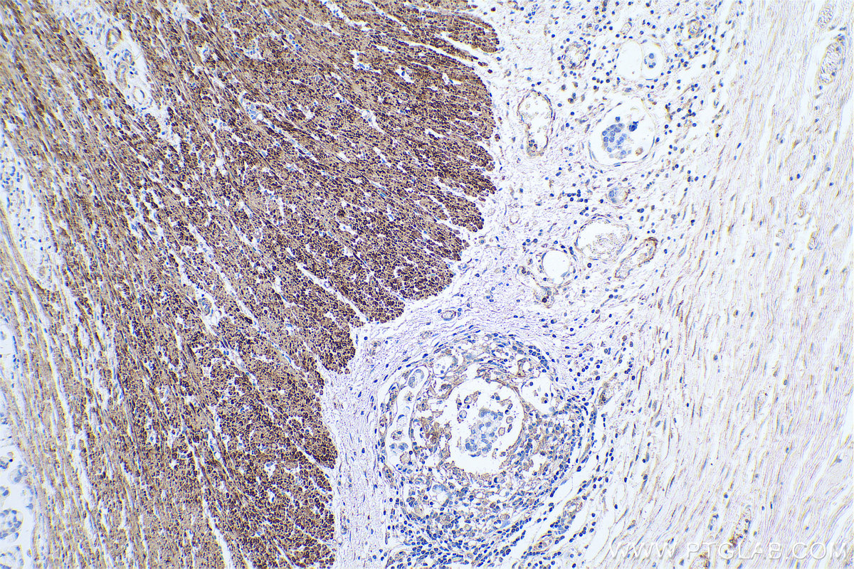 Immunohistochemical analysis of paraffin-embedded human colon cancer tissue slide using KHC0655 (FLNA IHC Kit).