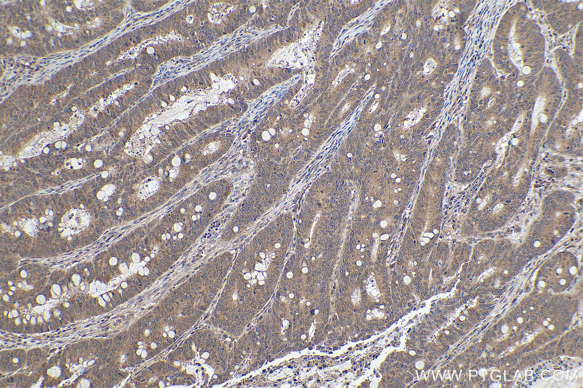 Immunohistochemical analysis of paraffin-embedded human colon cancer tissue slide using KHC0885 (FLYWCH2 IHC Kit).