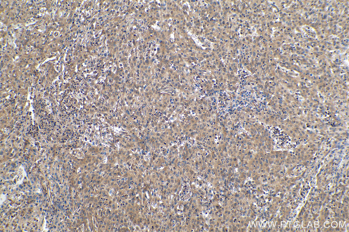 Immunohistochemical analysis of paraffin-embedded human cervical cancer tissue slide using KHC0885 (FLYWCH2 IHC Kit).