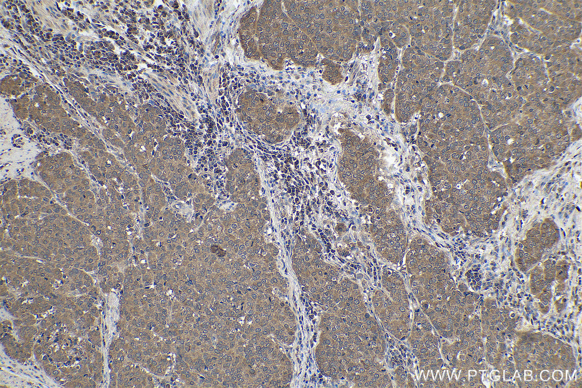 Immunohistochemical analysis of paraffin-embedded human stomach cancer tissue slide using KHC0885 (FLYWCH2 IHC Kit).