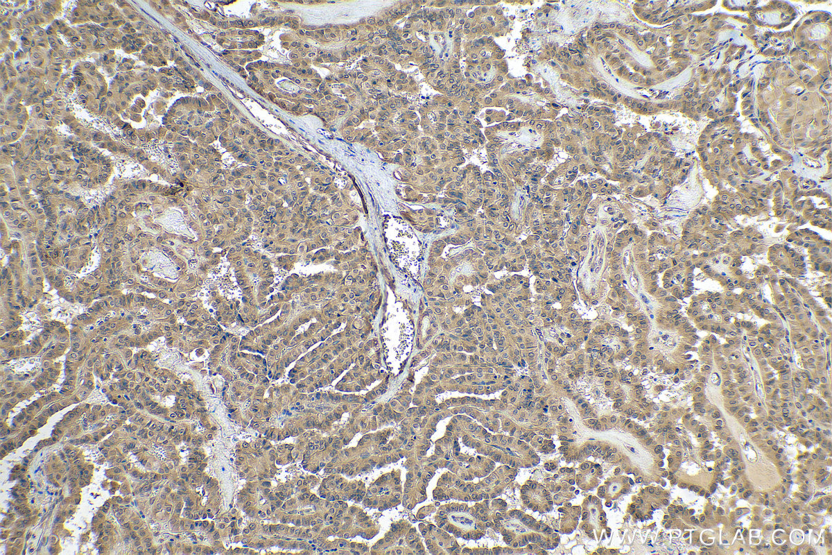 Immunohistochemical analysis of paraffin-embedded human thyroid cancer tissue slide using KHC0885 (FLYWCH2 IHC Kit).