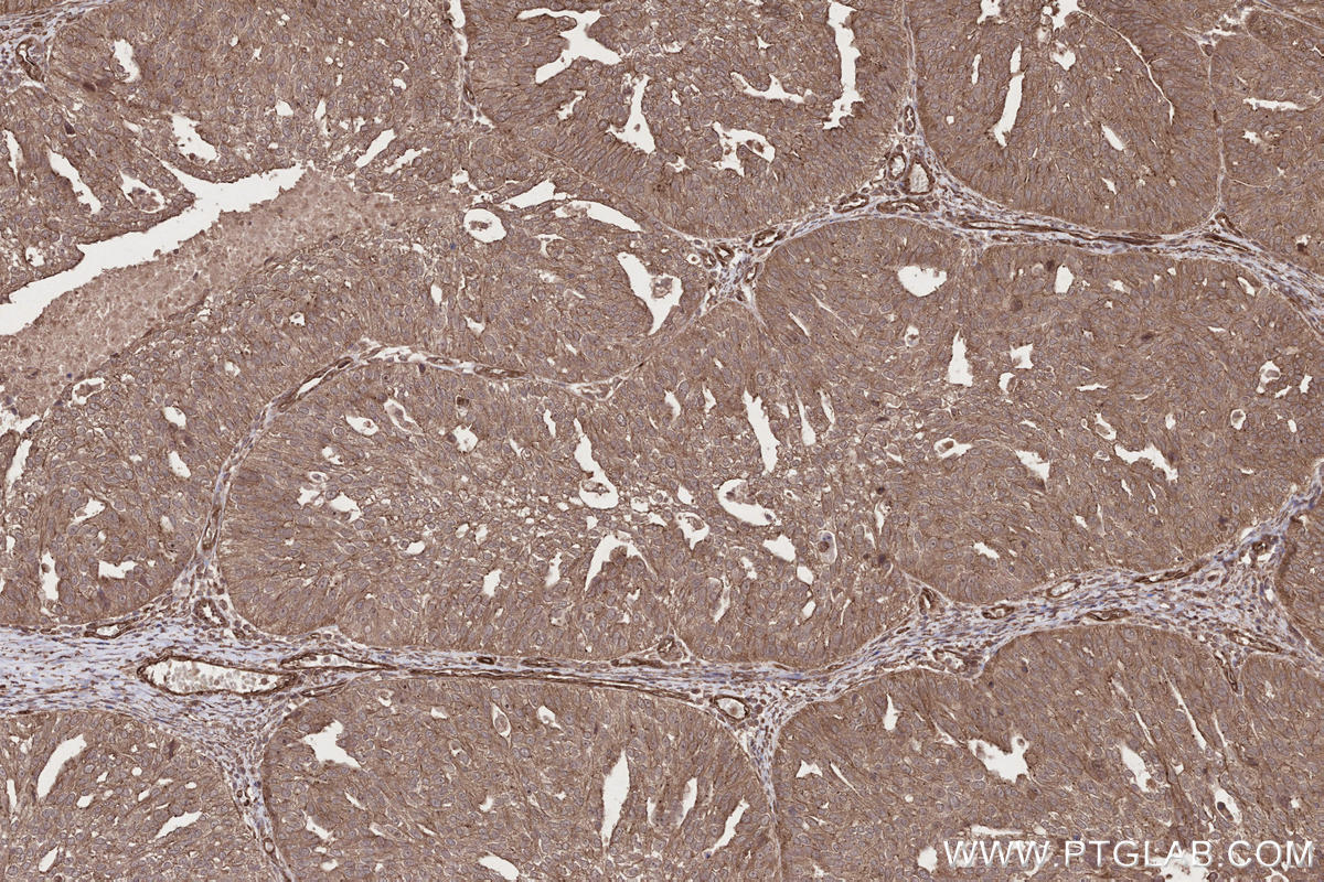 Immunohistochemical analysis of paraffin-embedded human ovary cancer tissue slide using KHC2646 (FMNL3 IHC Kit).