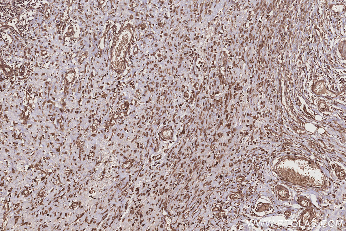 Immunohistochemical analysis of paraffin-embedded human colon cancer tissue slide using KHC3216 (FNTA IHC Kit).