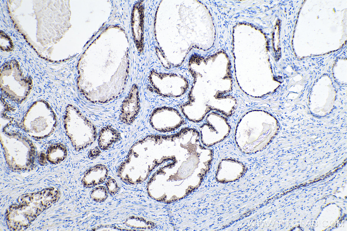 Immunohistochemical analysis of paraffin-embedded human prostate cancer tissue slide using KHC0139 (FOXA1 IHC Kit).