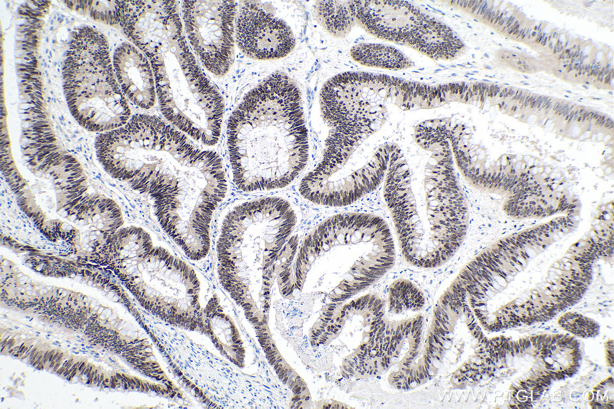 Immunohistochemical analysis of paraffin-embedded human colon cancer tissue slide using KHC0140 (FOXA2 IHC Kit).