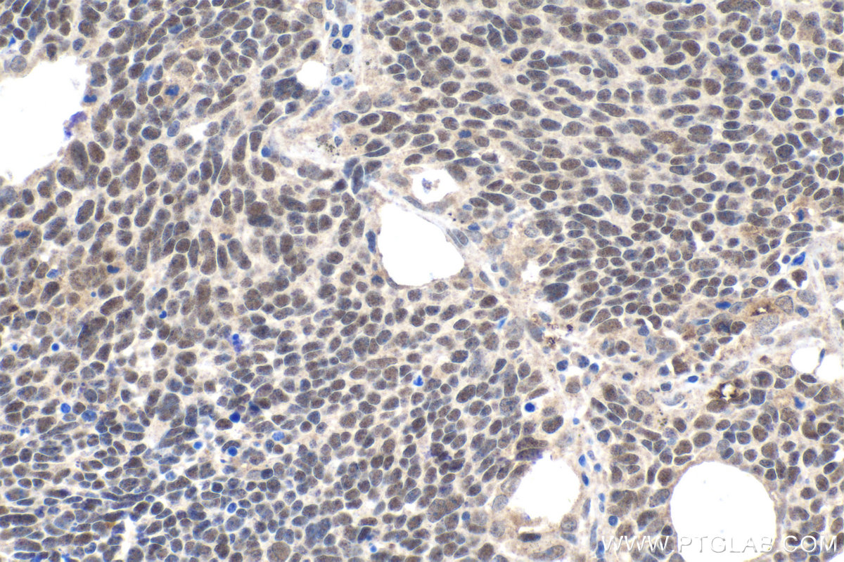 Immunohistochemical analysis of paraffin-embedded human lung cancer tissue slide using KHC1663 (FOXK2 IHC Kit).