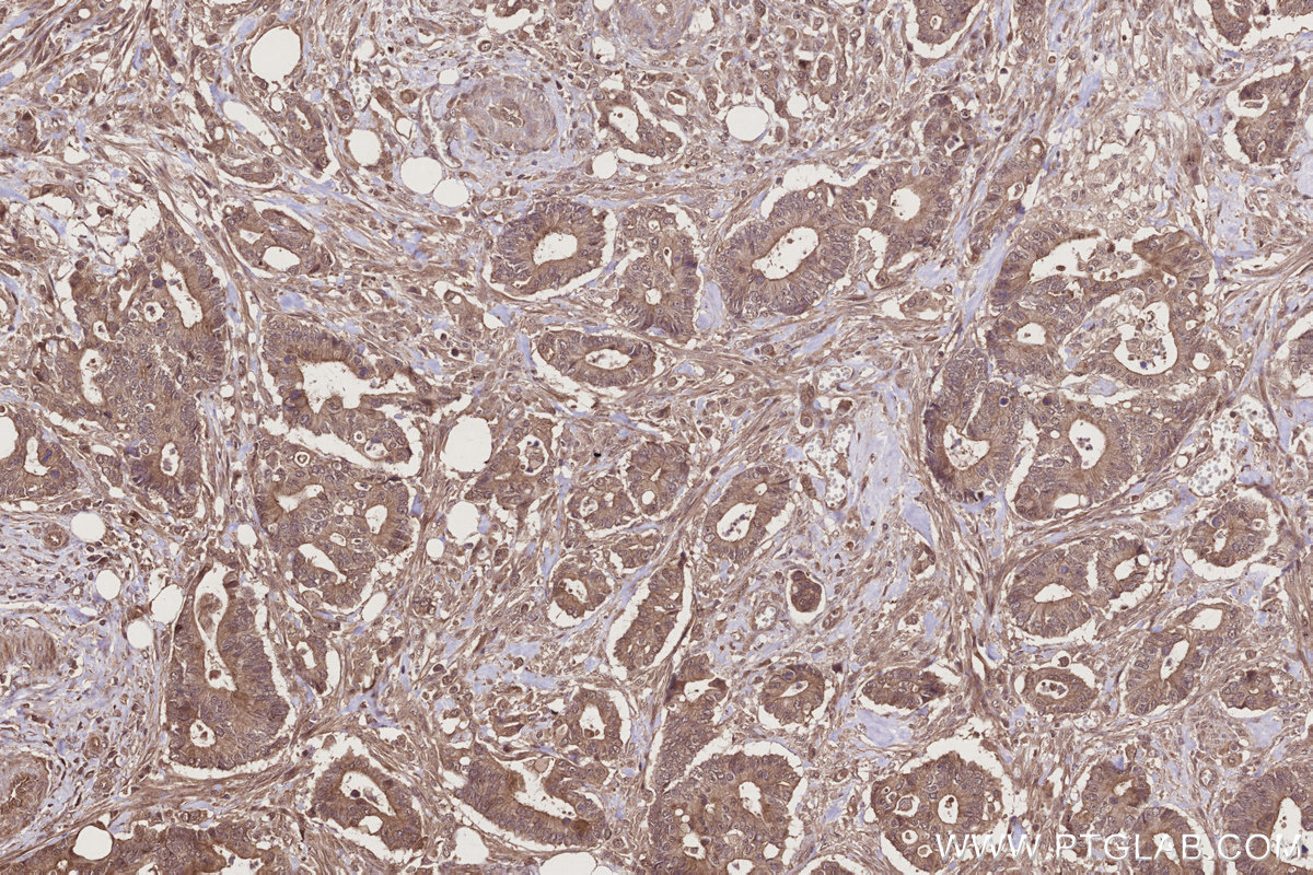 Immunohistochemical analysis of paraffin-embedded human rectal cancer tissue slide using KHC2731 (FRS2 IHC Kit).