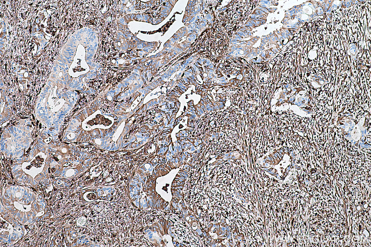 Immunohistochemical analysis of paraffin-embedded human colon cancer tissue slide using KHC0419 (FTL IHC Kit).