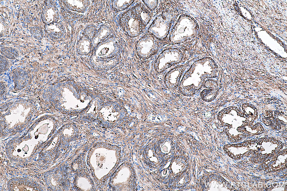 Immunohistochemical analysis of paraffin-embedded human prostate cancer tissue slide using KHC0419 (FTL IHC Kit).