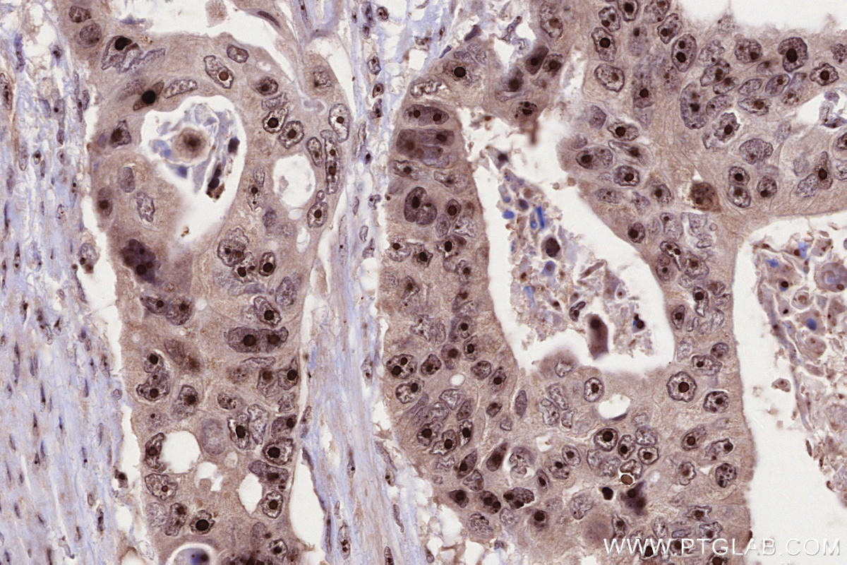 Immunohistochemical analysis of paraffin-embedded human stomach cancer tissue slide using KHC2657 (FTSJ3 IHC Kit).
