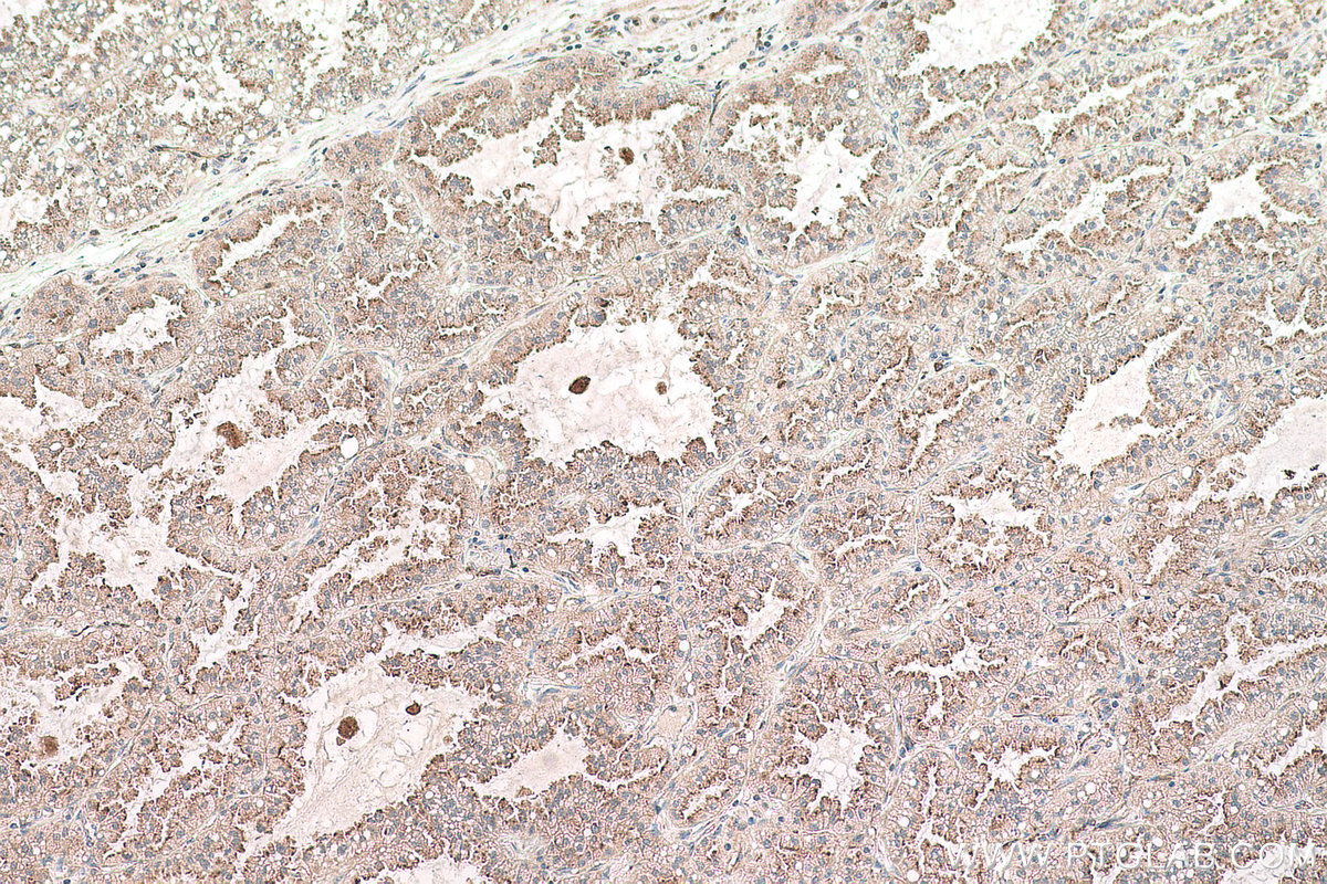 Immunohistochemical analysis of paraffin-embedded human lung cancer tissue slide using KHC0766 (FUCA1 IHC Kit).