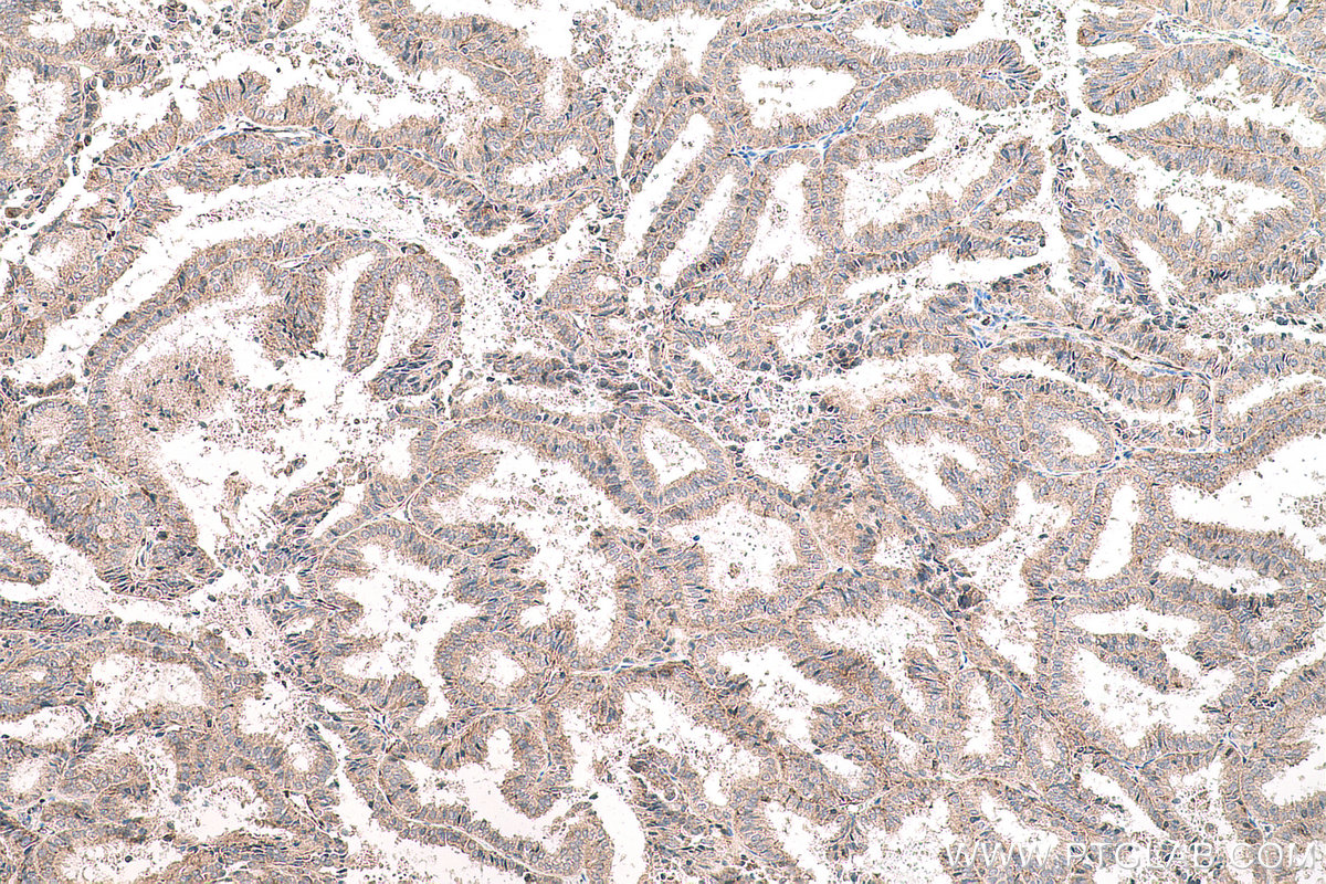 Immunohistochemical analysis of paraffin-embedded human ovary tumor tissue slide using KHC0766 (FUCA1 IHC Kit).