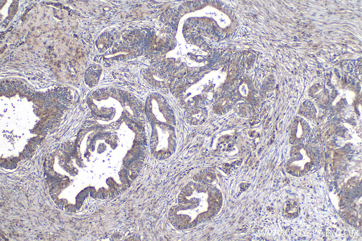 Immunohistochemical analysis of paraffin-embedded human pancreas cancer tissue slide using KHC1227 (FUT11 IHC Kit).